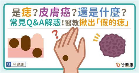 長毛的痣|是痣or皮膚癌？醫「1張圖秒對照」 長這2部位最危險